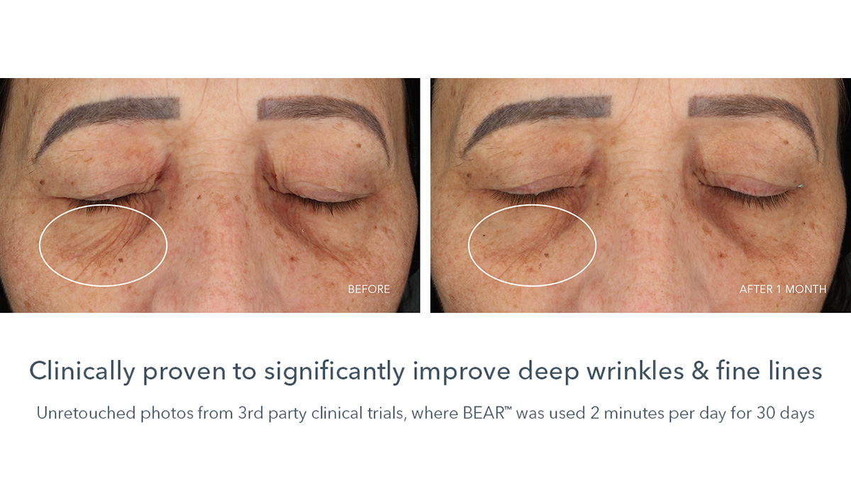 FOREO BEAR Review With Dermatologist Cara McDonald FOREO BEAR Review With Dermatologist Cara McDonald